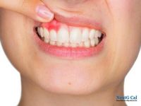 牙龈出血是什么原因-牙龈出血的治疗方法