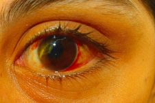 红眼病示例