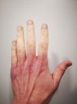 哪些指甲变化可能暗示严重疾病